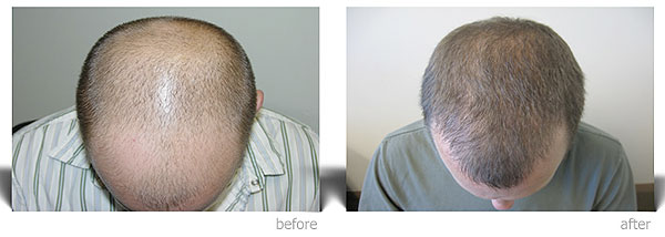 Ziering Medical hair