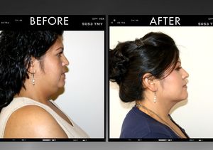 How to Shed Fat Without Painful Surgery | ExtraTV.com