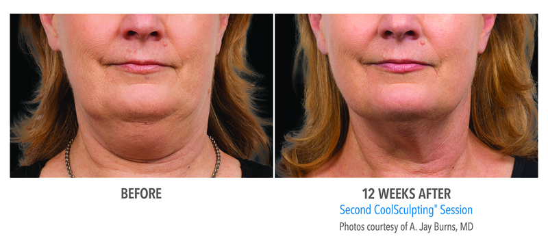 coolsculpting-resized